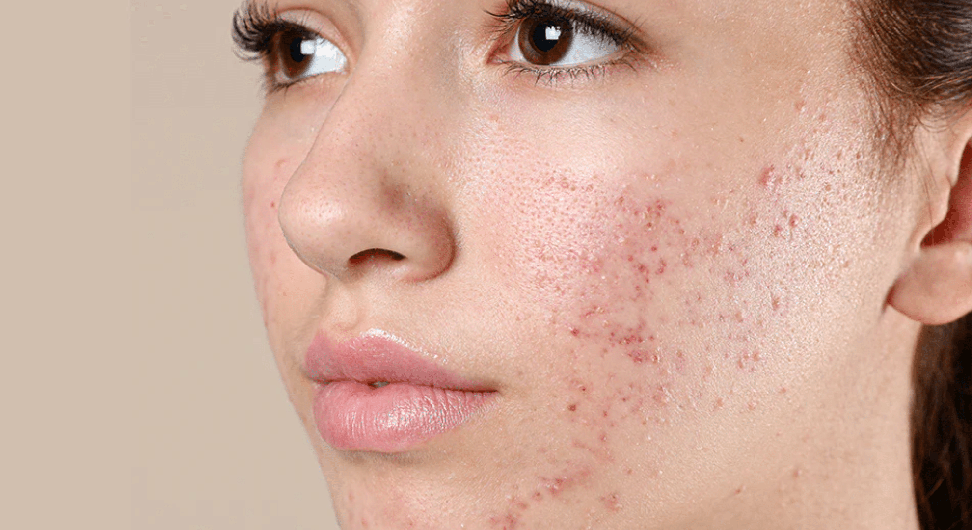 acne-oily-skin