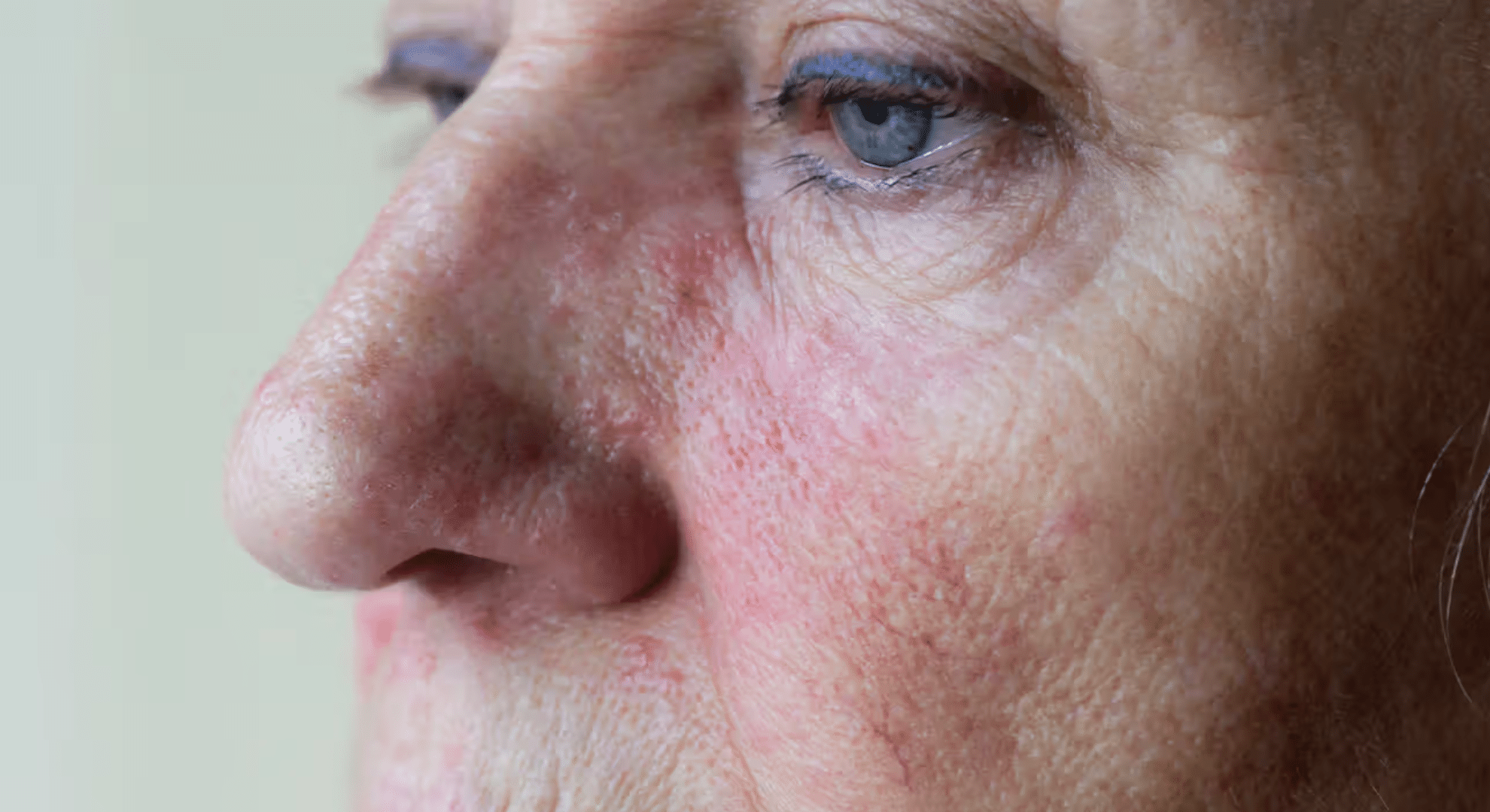 rosacea-eczema-psoriasis