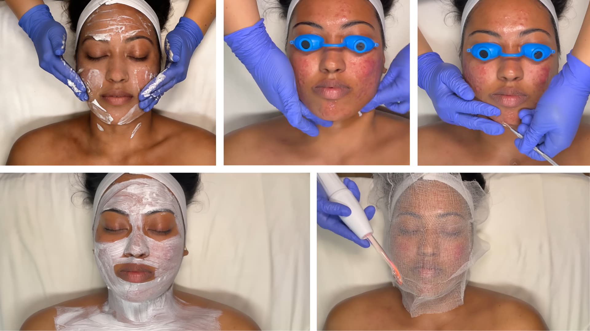 acne facial steps showing cleansing exfoliation extractions mask and led treatment on same person (1)