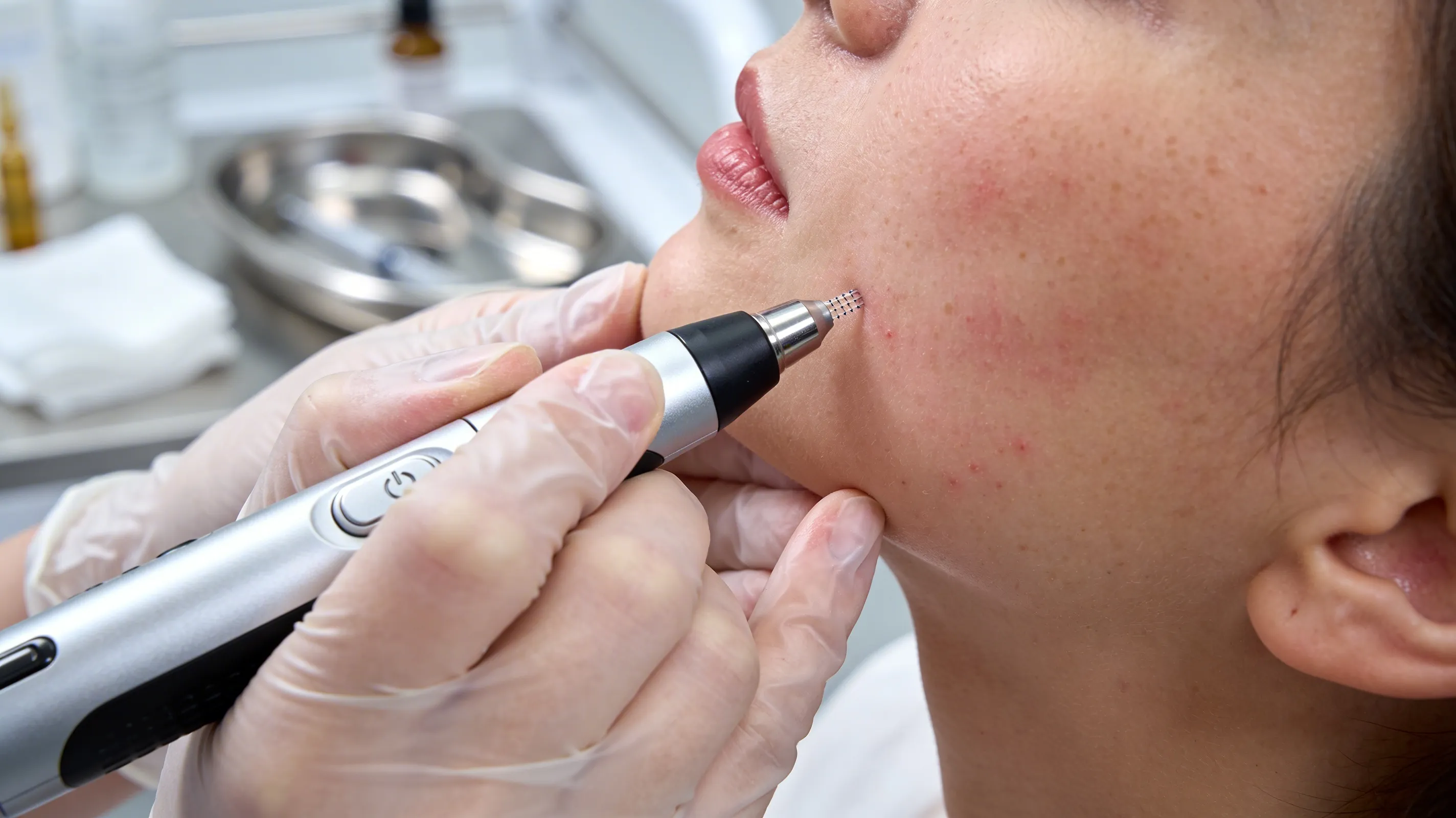 a trained skincare professional performing microneedling treatment on a client in a clean clinic setting (1)