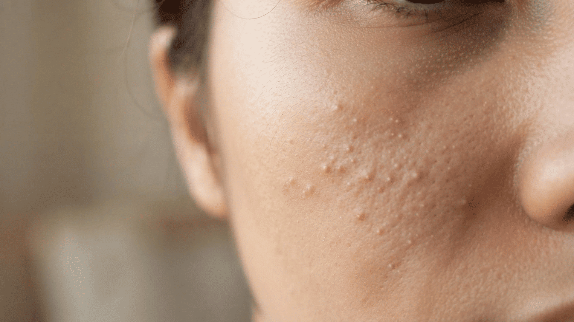 close-up view of whiteheads appearing as small skin-colored bumps on cheek skin