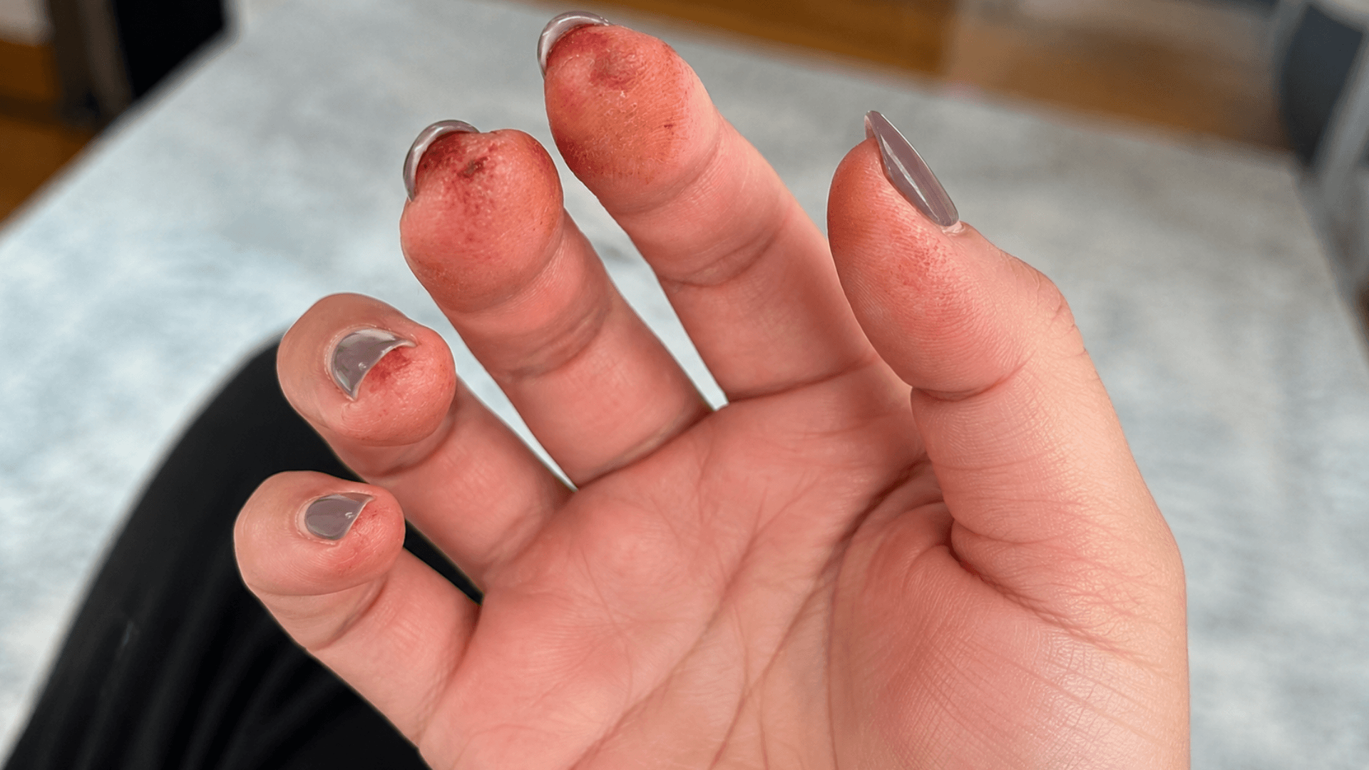 gel polish ingredients causing allergic reactions with red irritated skin around painted fingernails and cuticles