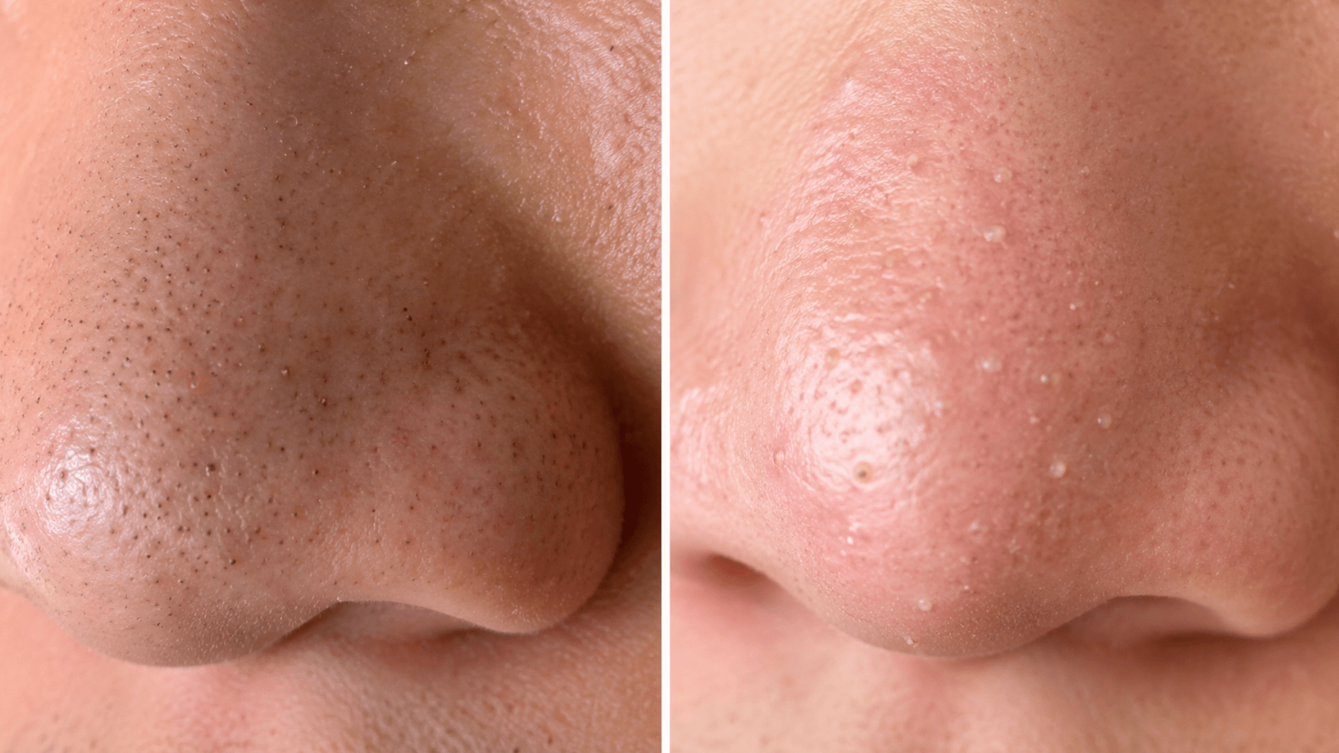 whiteheads-vs-blackheads